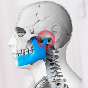 Rối loạn TMJ